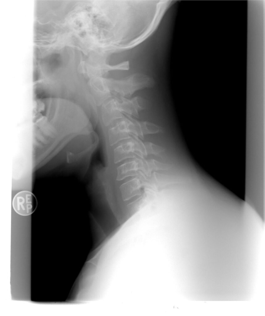 cervical spine, xray, patient, xray, xray, xray, xray, xray